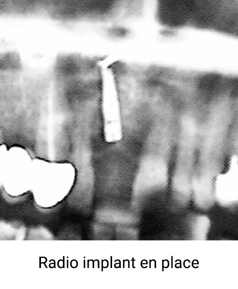 Radio-implant-en-place