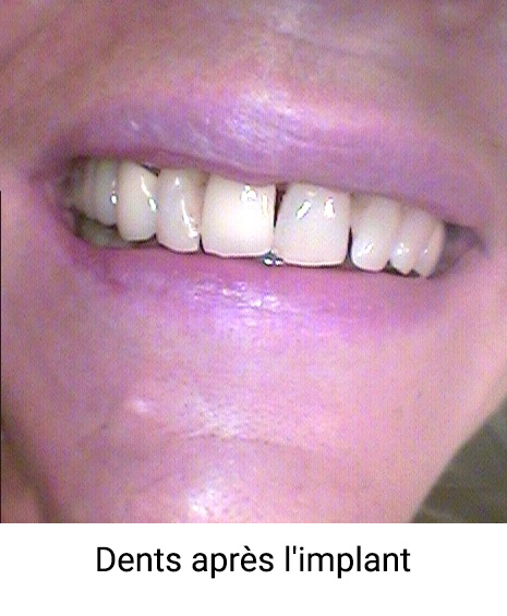 Dents-après-l'implant